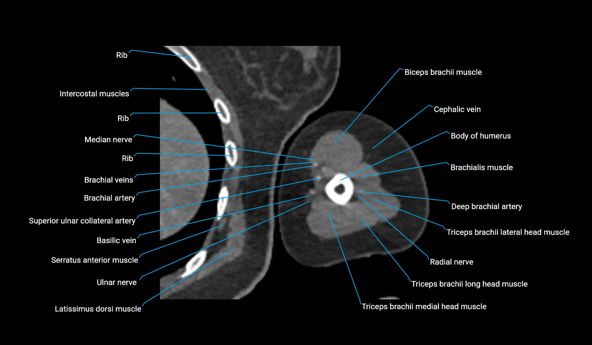 CT upper arm axial  cross sectional anatomy labelled radiology image -00262.webp